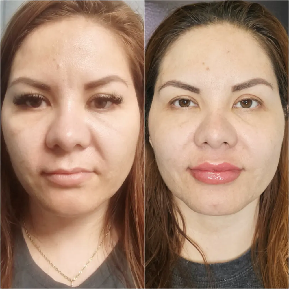 Antes y despues de armonizacion facial con acido hialuronico en vista frontal.