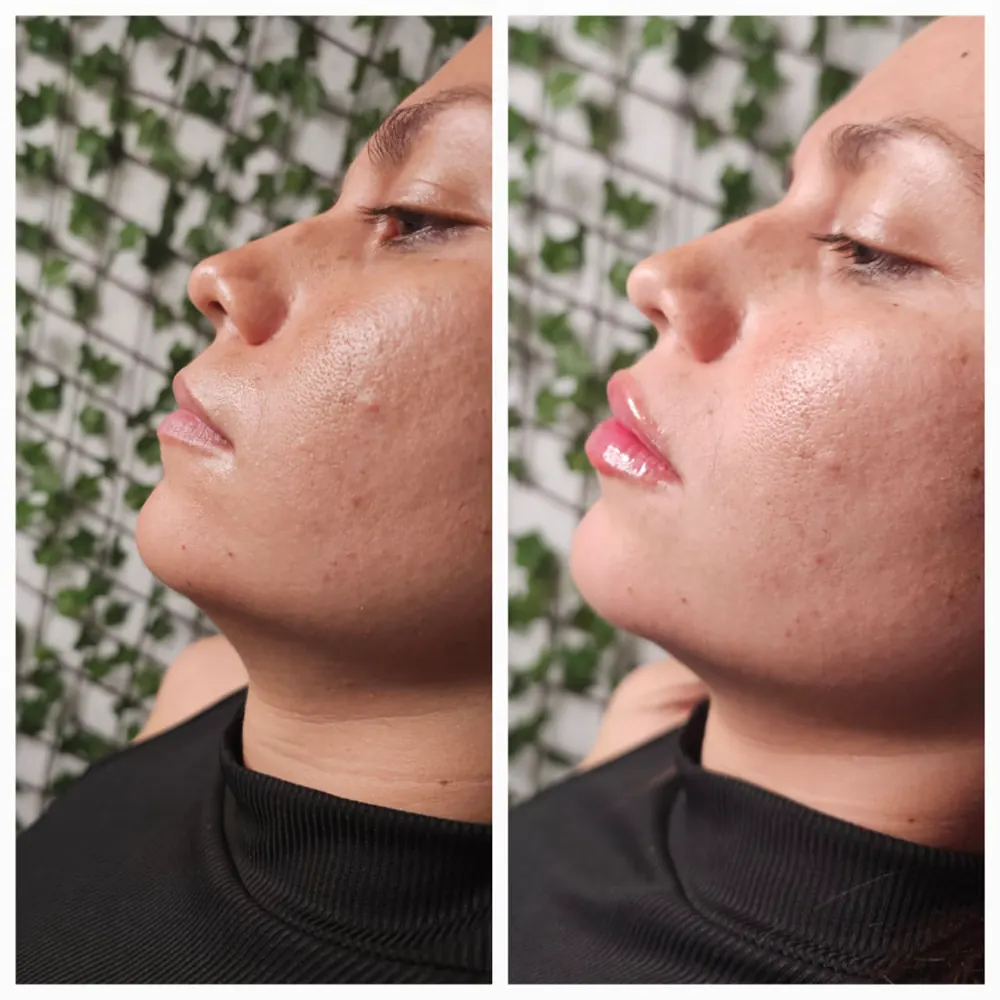 Antes y despues de armonizacion con acido hialuronico en vista de perfil.