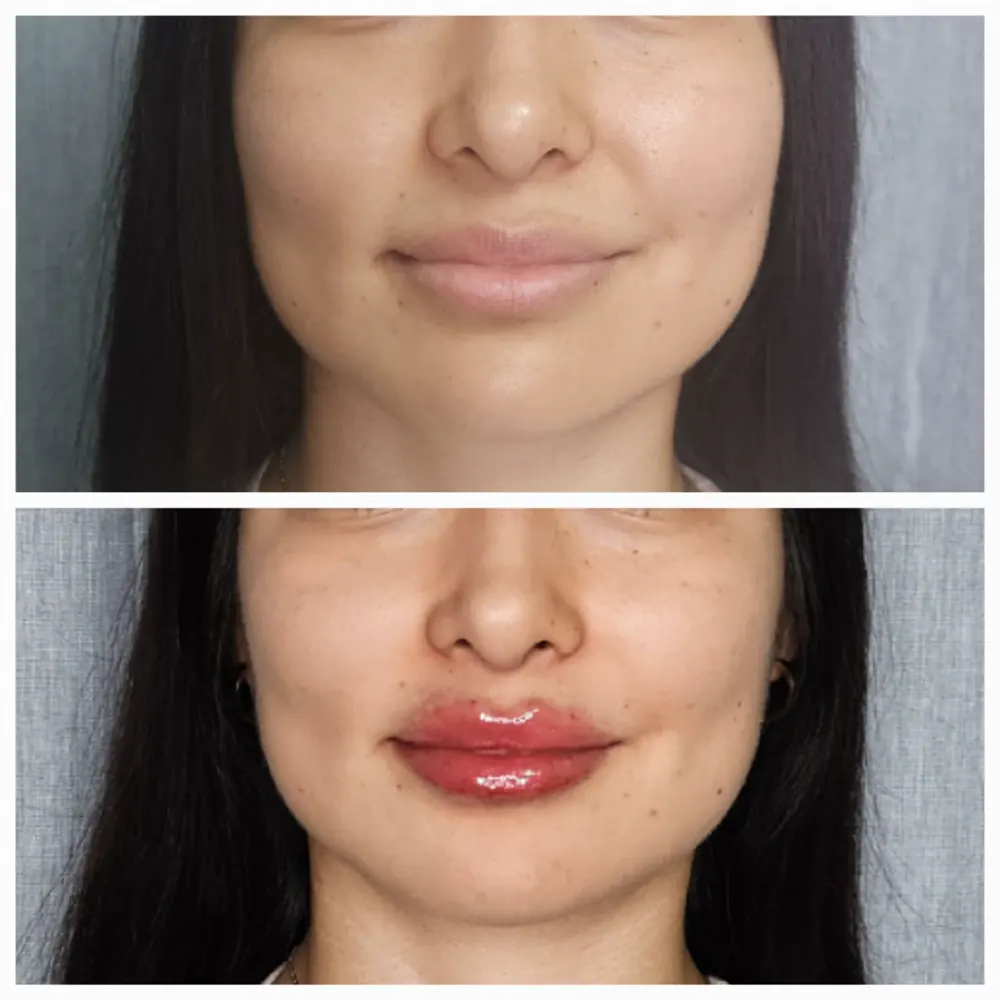 Antes y despues de relleno de labios con resultado natural.
