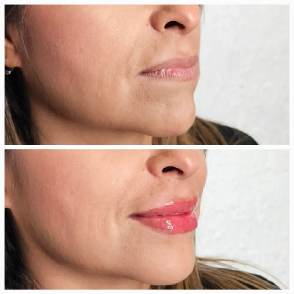 Antes y despues de relleno de labios en vista de perfil.