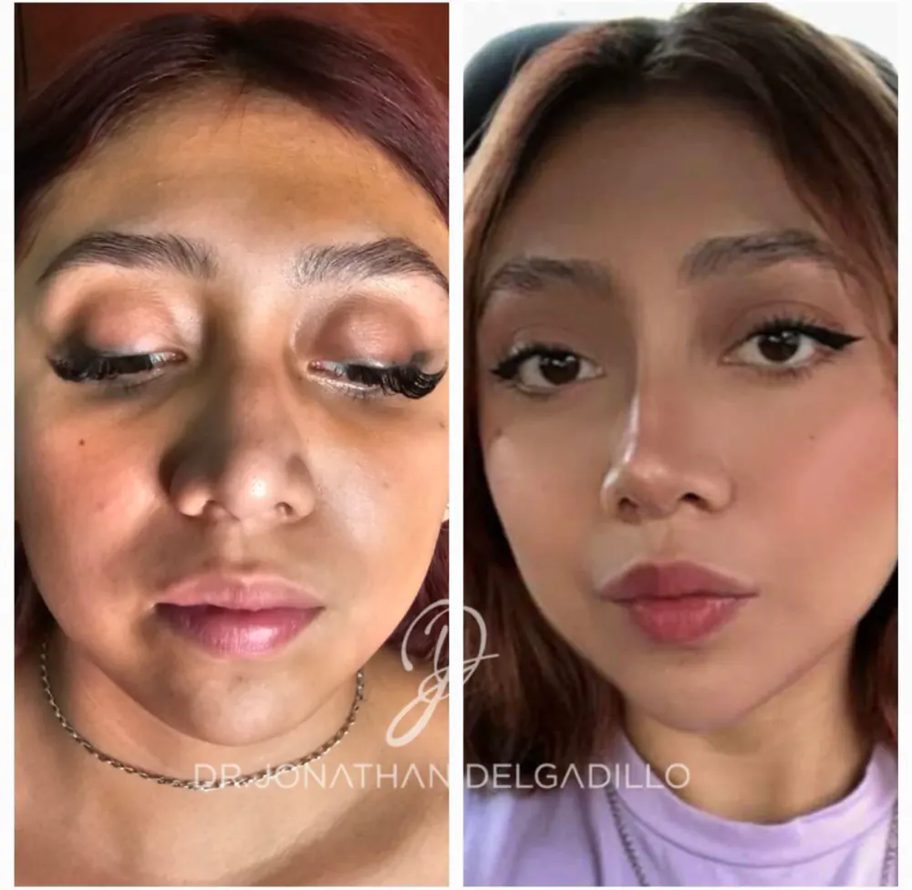 Antes y despues de rinomodelacion y armonizacion facial en vista frontal.