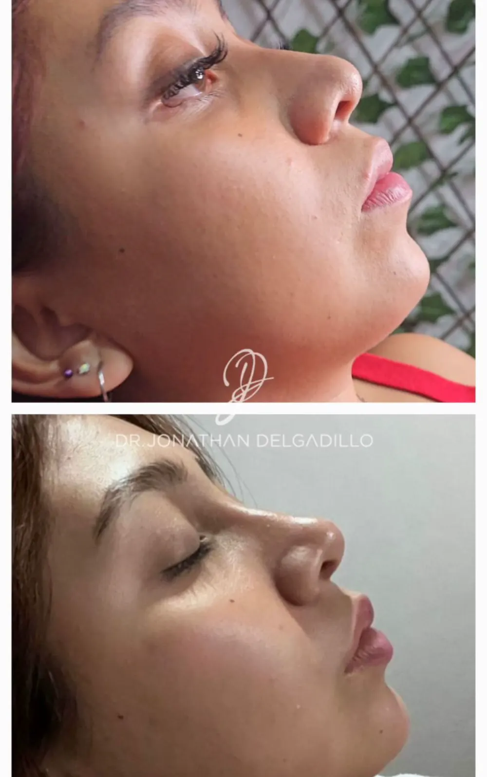 Antes y después de rinomodelación en vista de perfil.